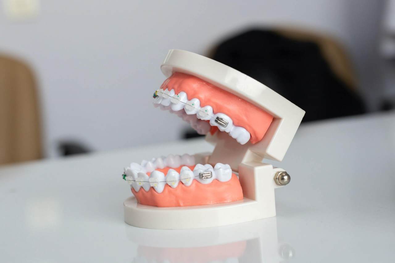 Getting Braces for Impacted Teeth – Will It Work?