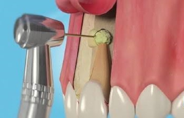 Benefits of Apicoectomy by westpoint dental clinic