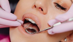 teeth cleaning - westpoint dental clinic - blacktown